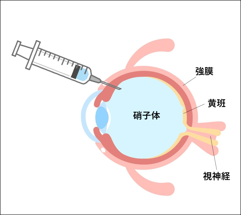 硝子体注射｜大阪鶴見まつやま眼科